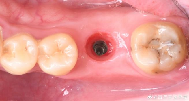 种牙后根充不到位为何会增加种植失败风险？如何通过影像学检查及时发现并处理？-图2