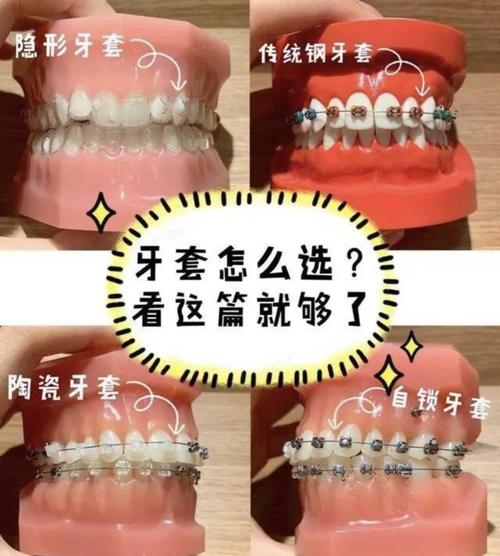 牙套有哪三种常见材料?不同材料各自的特点、适用情况及优缺点该如何区分选择呢?-图2 牙套有哪三种常见材料?不同材料各自的特点、适用情况及优缺点该如何区分选择呢?-图2