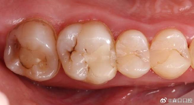 二类洞充填有哪些常用方法?不同充填材料的适用性及操作规范是什么?-图2 二类洞充填有哪些常用方法?不同充填材料的适用性及操作规范是什么?-图2