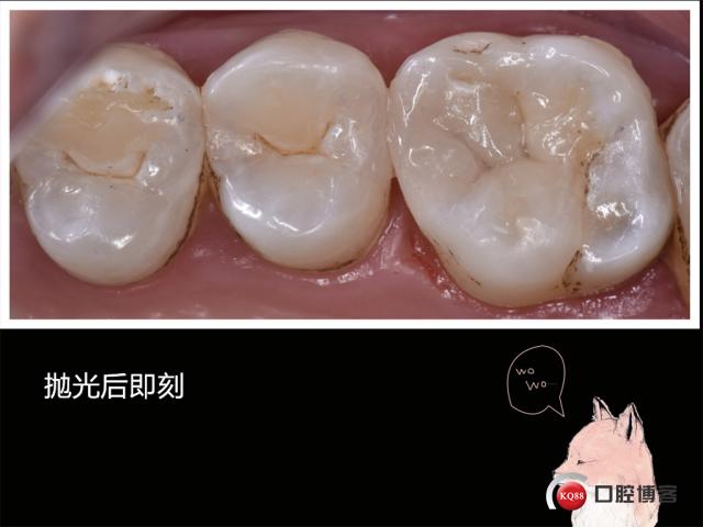 二类洞充填有哪些常用方法?不同充填材料的适用性及操作规范是什么?-图3 二类洞充填有哪些常用方法?不同充填材料的适用性及操作规范是什么?-图3