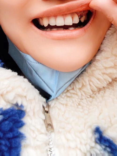 在辽宁省丹东市种牙，大家最关心哪些问题？比如价格多少、哪家医院靠谱、医保怎么报销、种植牙能用多久？-图2