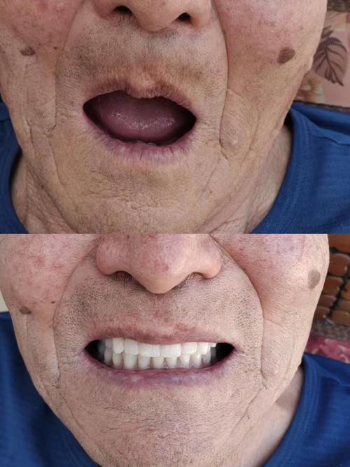 在辽宁省丹东市种牙，大家最关心哪些问题？比如价格多少、哪家医院靠谱、医保怎么报销、种植牙能用多久？-图1