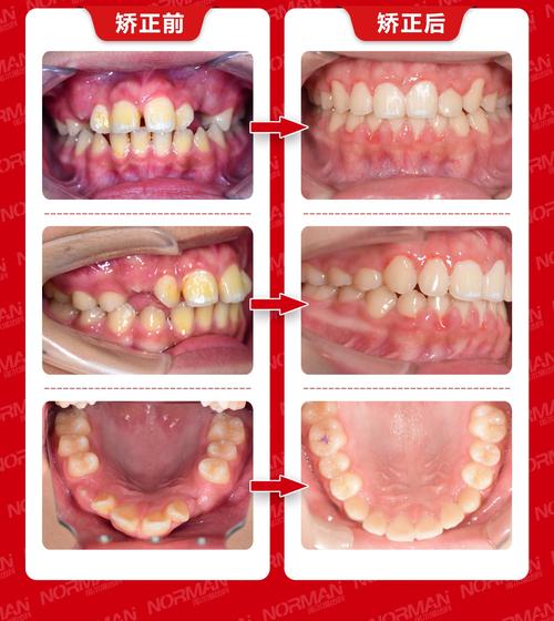 正畸复诊难道只是为了加力?其实每次复诊还有这些关键步骤你不知道!-图1 正畸复诊难道只是为了加力?其实每次复诊还有这些关键步骤你不知道!-图1