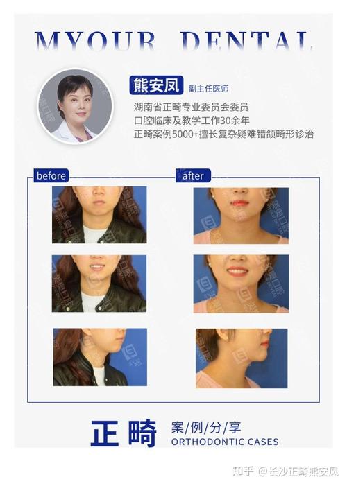 成人正畸和儿童正畸的区别究竟体现在哪些方面？生理基础、治疗目标及方案设计有何不同？-图2