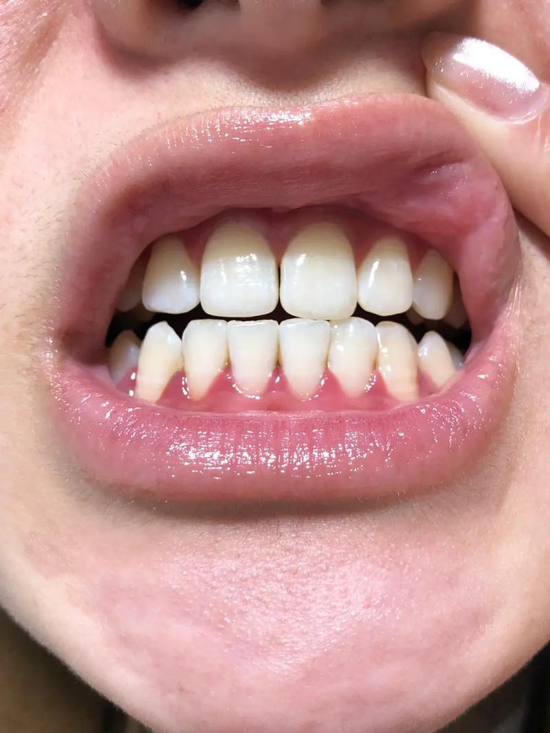 20岁正畸期间牙龈萎缩,是矫正器摩擦还是口腔护理不当导致?会影响牙齿稳固和矫正效果吗?-图3 20岁正畸期间牙龈萎缩,是矫正器摩擦还是口腔护理不当导致?会影响牙齿稳固和矫正效果吗?-图3