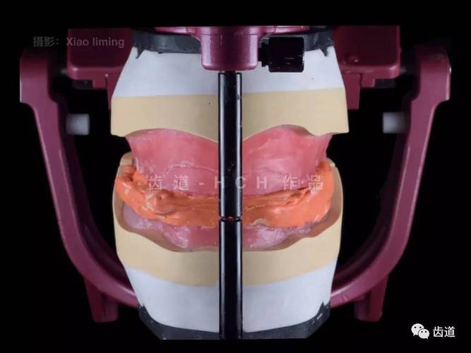 红膏二次印模方法的具体操作步骤是怎样的?如何确保其在口腔修复中的精准适配与稳定性?-图3 红膏二次印模方法的具体操作步骤是怎样的?如何确保其在口腔修复中的精准适配与稳定性?-图3