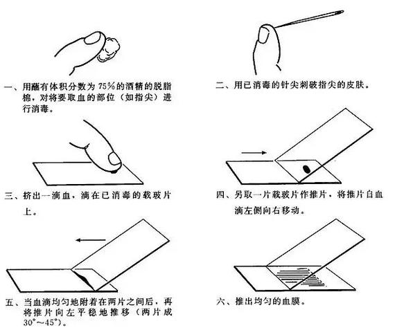 红膏二次印模方法的具体操作步骤是怎样的？如何确保其在口腔修复中的精准适配与稳定性？-图1