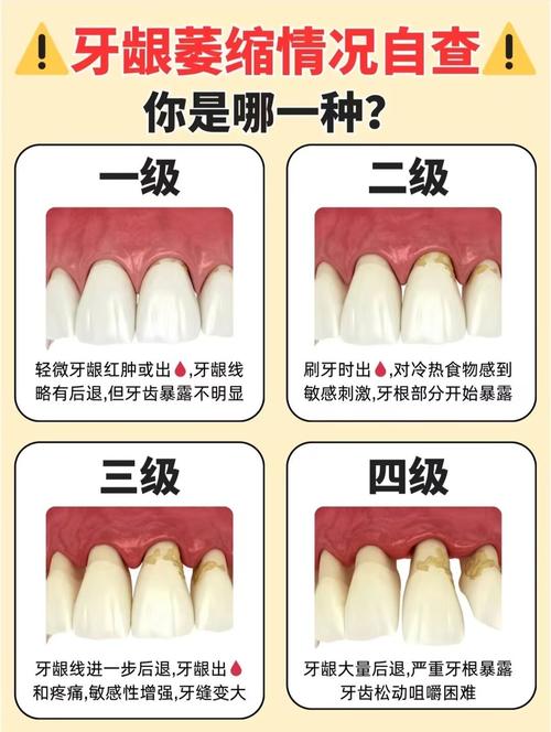 牙齿窝沟五种分型的划分标准是什么？不同分型对龋病预防及窝沟封闭术的选择有何指导意义？-图1
