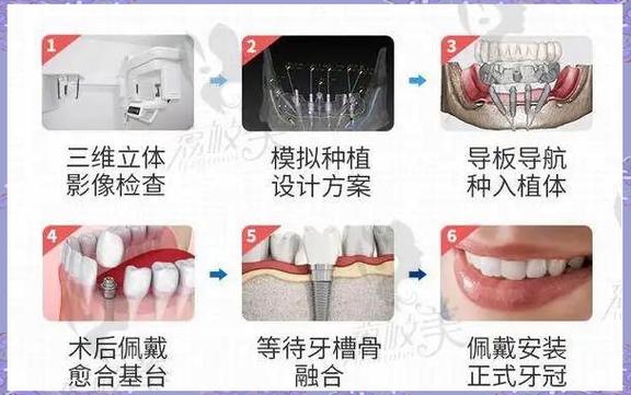 植牙中的即拔即种技术真的安全吗?拔牙后立即种植适合哪些人群?长期效果会比传统植牙更好吗?-图2 植牙中的即拔即种技术真的安全吗?拔牙后立即种植适合哪些人群?长期效果会比传统植牙更好吗?-图2