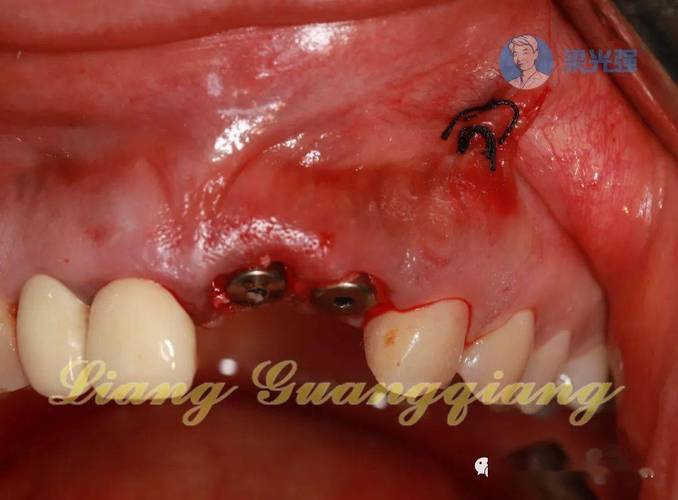 种骨和植牙全过程是怎样的？种骨是植牙的必经步骤吗？两者具体操作步骤、注意事项及术后效果差异有哪些？-图3