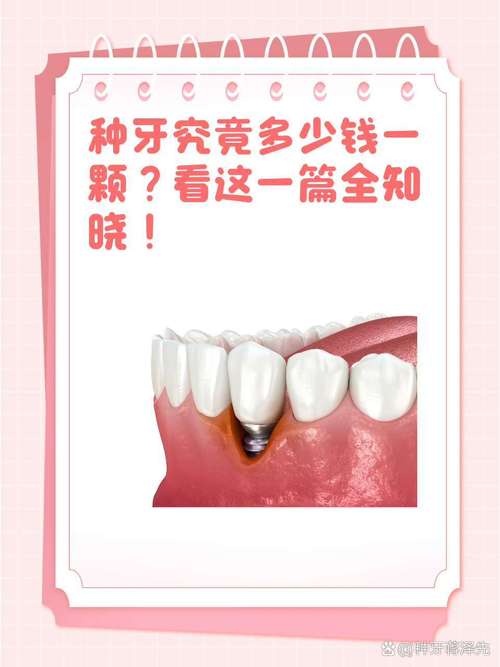 种植牙一颗的成本与利润空间有多大？医生和机构的收益分配比例究竟是怎样的？-图3