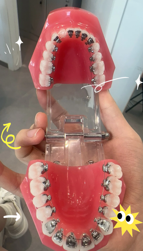 口腔正畸舌侧矫治技术虽美观隐蔽,但操作复杂度高、费用昂贵,其临床效果真的优于传统托槽矫治吗?适合哪些错颌畸形患者?-图2 口腔正畸舌侧矫治技术虽美观隐蔽,但操作复杂度高、费用昂贵,其临床效果真的优于传统托槽矫治吗?适合哪些错颌畸形患者?-图2