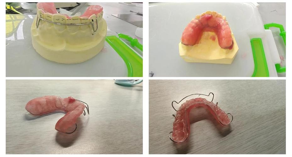 牙合垫主要分为哪两种类型?它们各自的设计原理、适用症状及临床应用场景有何不同?-图1 牙合垫主要分为哪两种类型?它们各自的设计原理、适用症状及临床应用场景有何不同?-图1