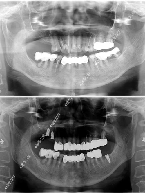 公立医院种一颗牙，价格是否透明？技术是否可靠？与私立医院相比就诊体验和性价比如何？-图3