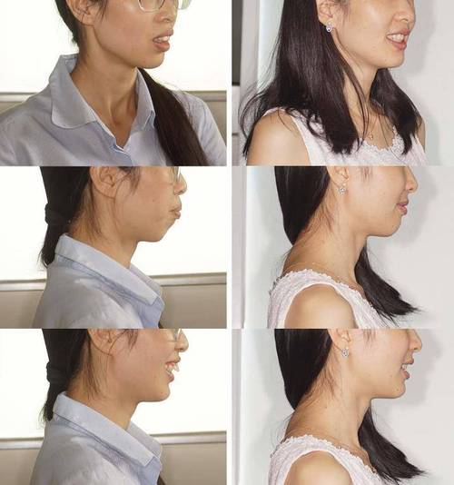 龅牙正颌手术前为何必须进行术前正畸?其具体作用、时长及对手术效果和术后恢复的关键影响是什么?-图2 龅牙正颌手术前为何必须进行术前正畸?其具体作用、时长及对手术效果和术后恢复的关键影响是什么?-图2