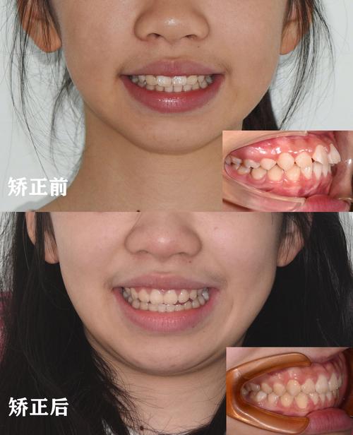 龅牙正颌手术前为何必须进行术前正畸?其具体作用、时长及对手术效果和术后恢复的关键影响是什么?-图1 龅牙正颌手术前为何必须进行术前正畸?其具体作用、时长及对手术效果和术后恢复的关键影响是什么?-图1