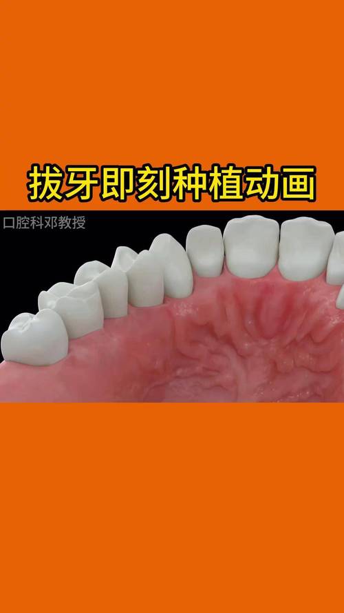 即拔即种牙过程中是否需要缝合?这种操作会影响术后恢复速度和种植体稳定性吗?-图1 即拔即种牙过程中是否需要缝合?这种操作会影响术后恢复速度和种植体稳定性吗?-图1