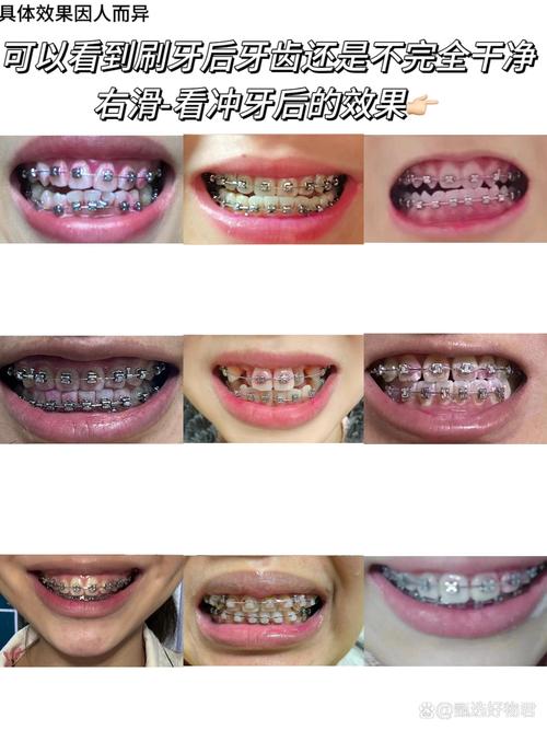 正畸治疗真的会导致牙齿坏死吗?牙根吸收、牙髓坏死的风险究竟有多大?-图3 正畸治疗真的会导致牙齿坏死吗?牙根吸收、牙髓坏死的风险究竟有多大?-图3