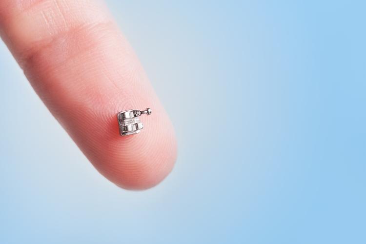 牙齿正畸时托槽突然掉了是什么原因导致的?需要马上处理吗?会不会影响最终的矫正效果?-图1 牙齿正畸时托槽突然掉了是什么原因导致的?需要马上处理吗?会不会影响最终的矫正效果?-图1