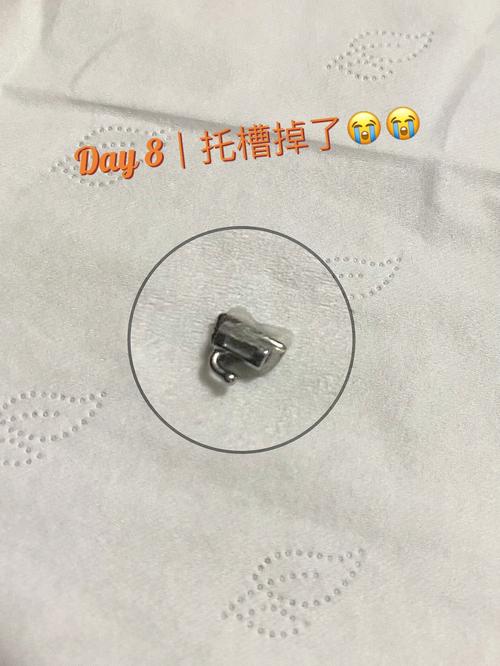 牙齿正畸时托槽突然掉了是什么原因导致的?需要马上处理吗?会不会影响最终的矫正效果?-图2 牙齿正畸时托槽突然掉了是什么原因导致的?需要马上处理吗?会不会影响最终的矫正效果?-图2