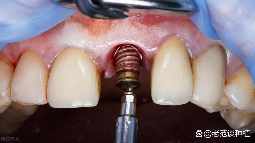 大同红十字机构是否真的开展种植牙项目？公益性质与商业运营如何界定，医疗资质与价格透明度有无保障？-图3