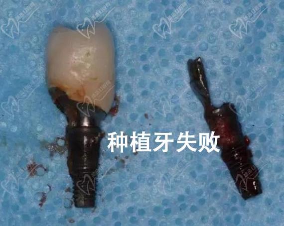 种牙一段式失败率为何居高不下?背后隐藏哪些技术风险与术后隐患?-图3 种牙一段式失败率为何居高不下?背后隐藏哪些技术风险与术后隐患?-图3