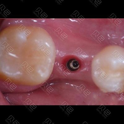 谭包生谈微创种牙,这项技术如何实现创伤小、恢复快?哪些人群更适合选择?安全性有保障吗?-图3 谭包生谈微创种牙,这项技术如何实现创伤小、恢复快?哪些人群更适合选择?安全性有保障吗?-图3