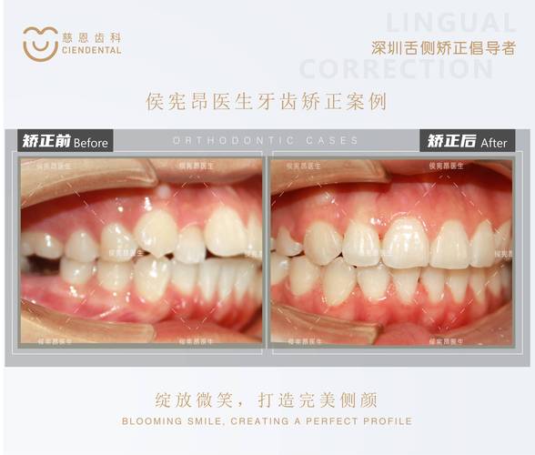房兵医生亲自操刀的正畸案例，效果是否真的比普通案例更出众？背后藏着哪些不为人知的技术细节？-图2