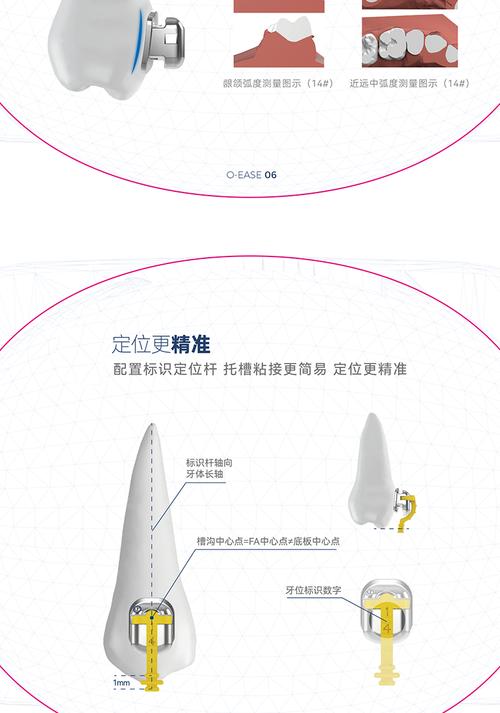 正畸托槽设计方案模板如何兼顾标准化流程与复杂病例的个性化需求？-图2