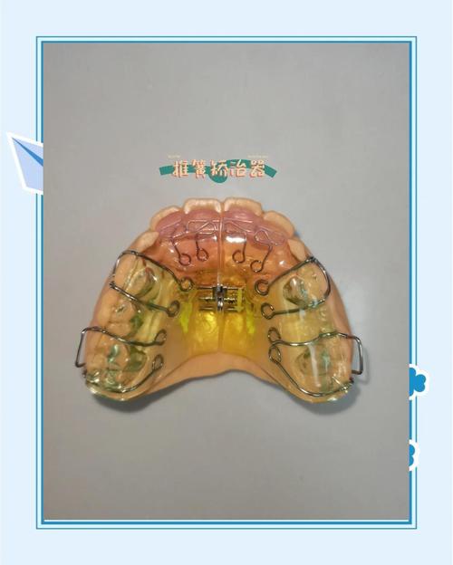 颌垫舌簧的正确使用方法是什么?具体操作步骤和注意事项有哪些?-图1 颌垫舌簧的正确使用方法是什么?具体操作步骤和注意事项有哪些?-图1