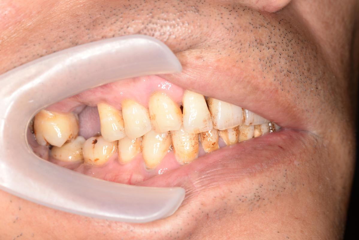 种完牙满一年后是否就能安全抽烟?这样做会对种植体寿命、牙龈健康及口腔环境产生哪些潜在影响?-图3 种完牙满一年后是否就能安全抽烟?这样做会对种植体寿命、牙龈健康及口腔环境产生哪些潜在影响?-图3