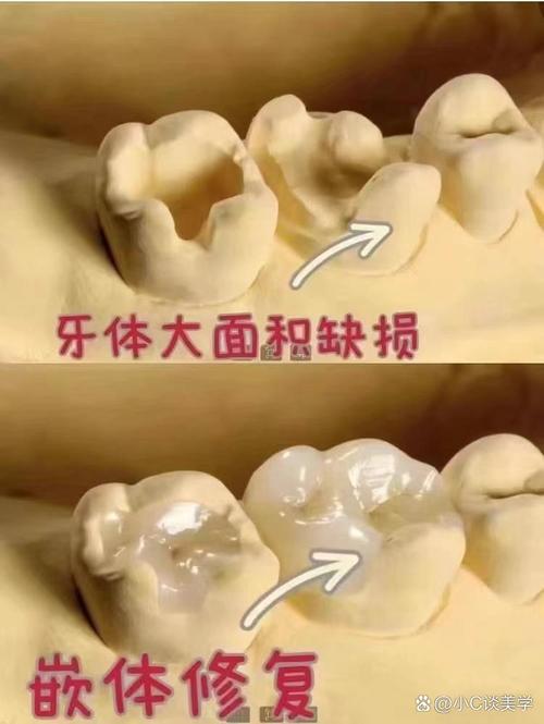 牙嵌体究竟属于哪种牙科修复体类型？与传统充填体、全冠等修复方式有何本质区别？-图1