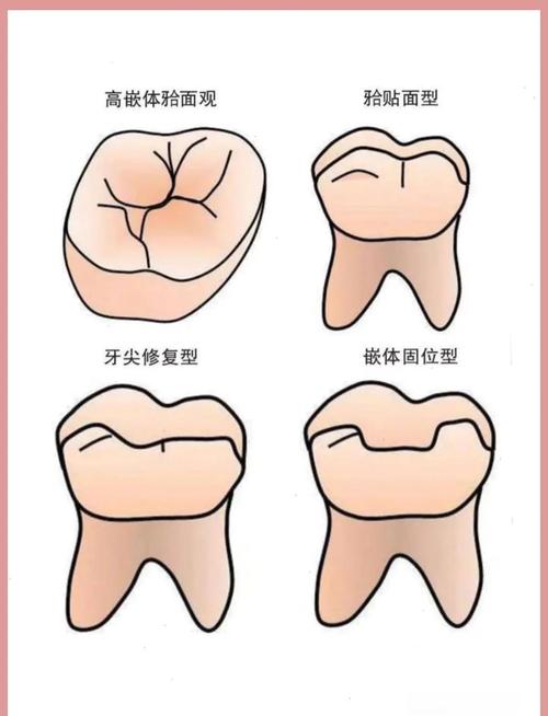 牙嵌体究竟属于哪种牙科修复体类型?与传统充填体、全冠等修复方式有何本质区别?-图2 牙嵌体究竟属于哪种牙科修复体类型?与传统充填体、全冠等修复方式有何本质区别?-图2