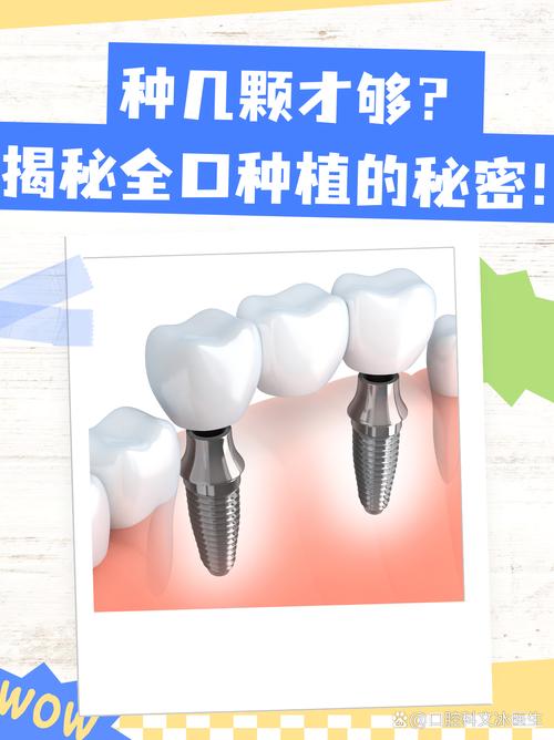 全口种牙好不好呢-图2