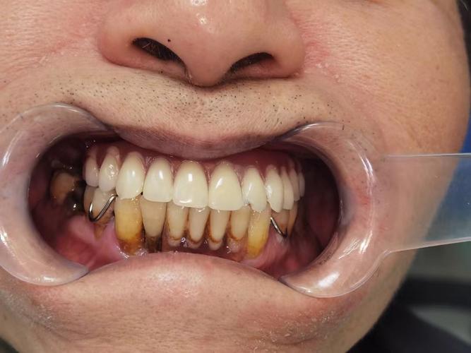 全口种牙好不好呢-图1