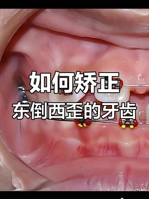 磨牙向外倾斜怎么正畸?不同矫正方案的效果、适用人群及注意事项有哪些?-图1 磨牙向外倾斜怎么正畸?不同矫正方案的效果、适用人群及注意事项有哪些?-图1