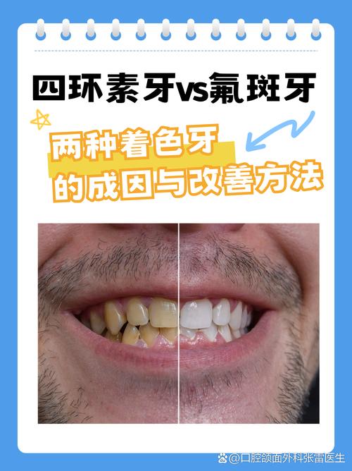 氟斑牙的解决方法有哪些？不同治疗方式适用哪些情况，如何选择适合自己的方案？-图2