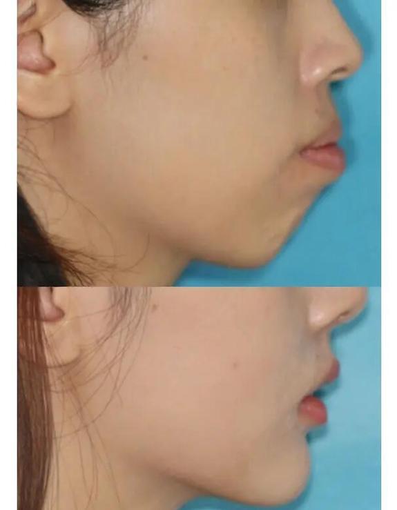 上颌窦区域牙齿存在问题时,正畸治疗可行吗?有哪些风险和注意事项?-图2 上颌窦区域牙齿存在问题时,正畸治疗可行吗?有哪些风险和注意事项?-图2