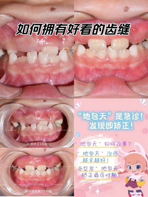 兜兜齿矫正有哪些常见方法？不同年龄段适合哪种方案？矫正过程中需要注意什么？-图3