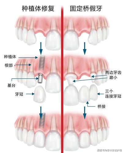 种牙植骨的全过程包含哪些关键步骤？术前评估、植骨手术到最终戴牙，每个阶段有哪些注意事项和风险？-图2