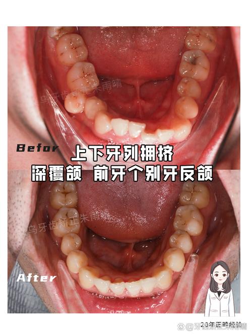 不拔牙正畸后牙齿向外移动，是方案设计问题还是术后护理不当？会对咬合功能和面部美观产生哪些影响？-图3