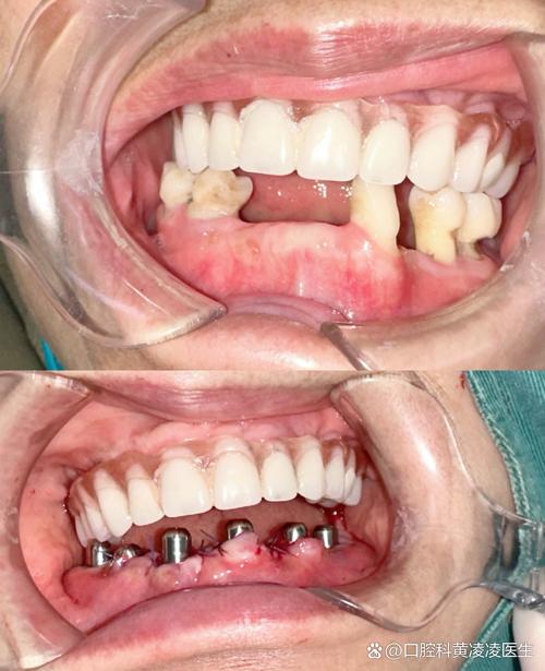 不拔牙正畸后牙齿向外移动，是方案设计问题还是术后护理不当？会对咬合功能和面部美观产生哪些影响？-图2