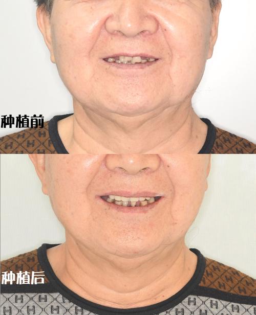 半口种牙后到底能不能吸烟?这样做会对种植体存活和口腔恢复期造成哪些不可逆的影响?-图2 半口种牙后到底能不能吸烟?这样做会对种植体存活和口腔恢复期造成哪些不可逆的影响?-图2