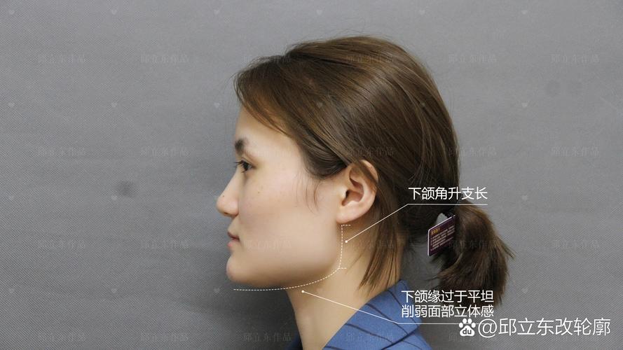 颧骨宽大的人群正畸真的能改善面型吗？会不会因颧骨条件限制效果？医生如何制定个性化方案？-图1