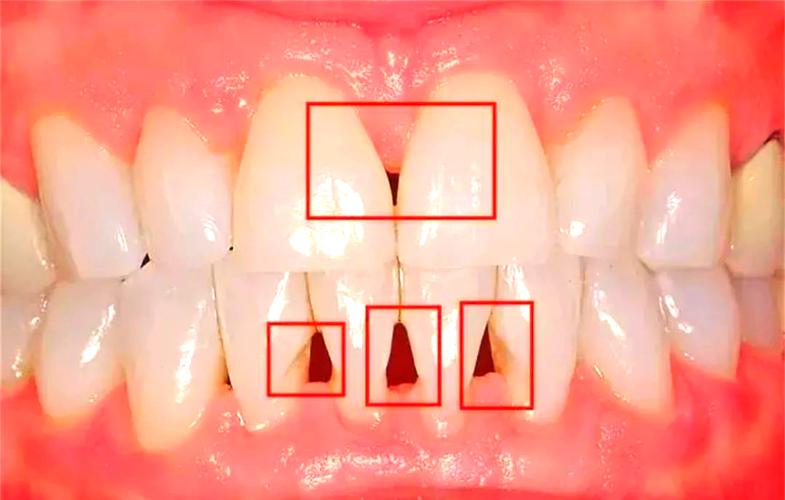 牙齿黑三角是怎么形成的？会对牙齿健康和美观造成哪些影响？有哪些科学有效的解决方法？-图2
