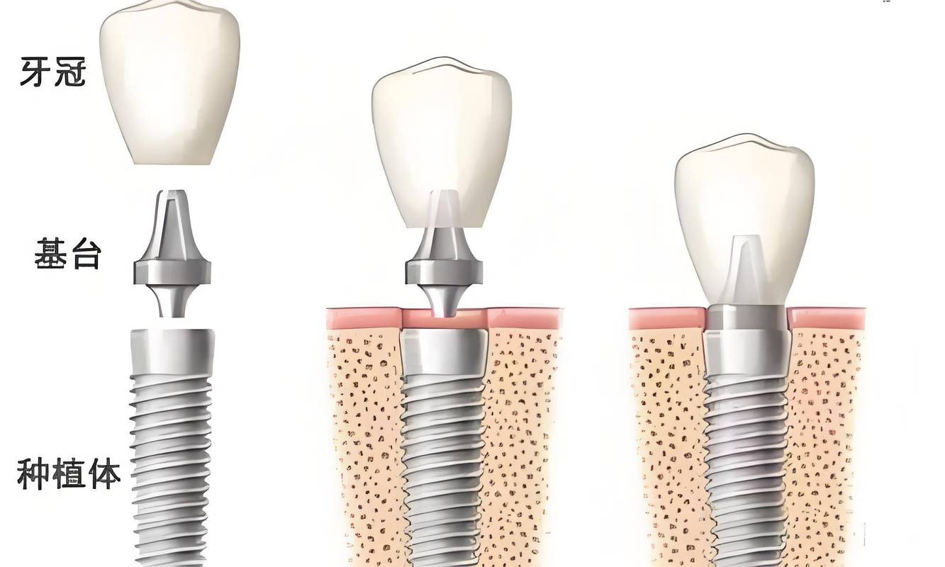 种植体松动是什么原因导致的?出现松动后该如何处理才能避免种植牙失败?-图3 种植体松动是什么原因导致的?出现松动后该如何处理才能避免种植牙失败?-图3