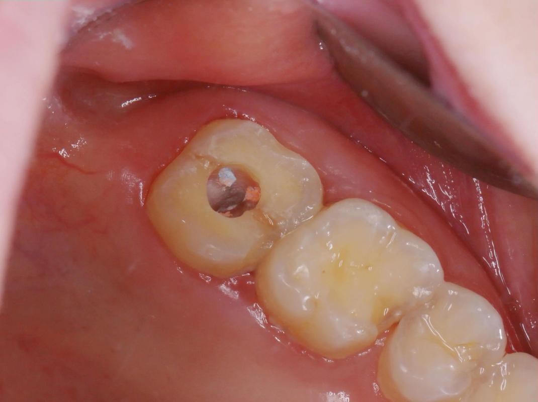 牙槽突裂的治疗方法有哪些?不同修复方式的效果与适用情况如何?-图1 牙槽突裂的治疗方法有哪些?不同修复方式的效果与适用情况如何?-图1