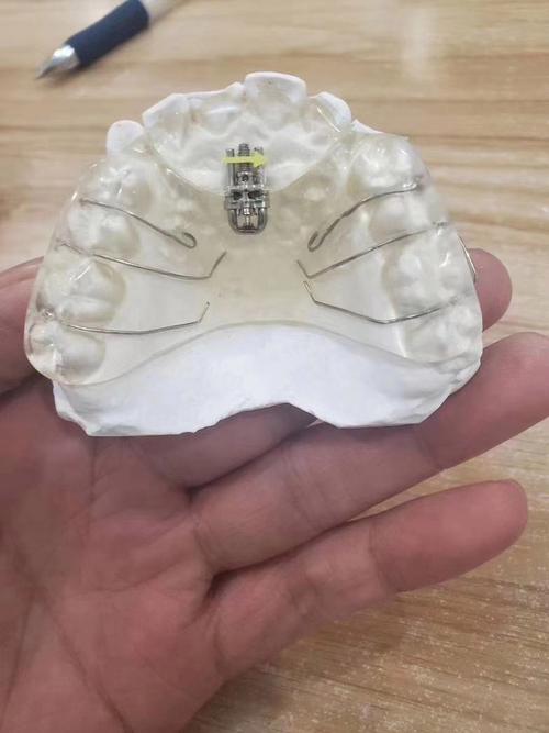 MRC肌功能矫正正畸与传统正畸有何本质区别？它如何通过肌肉训练实现牙齿与颌面的协同矫正？-图3