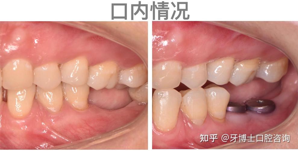 广州市种牙哪里好？想找靠谱医院和医生，价格透明、服务好的机构怎么选？-图3