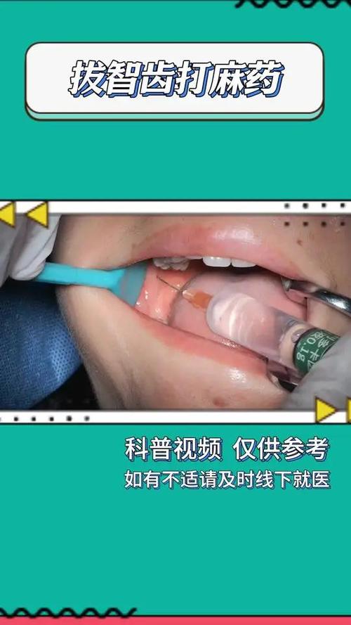 视频微创拨牙方法究竟是什么？它与传统拨牙相比有哪些独特优势，又适合哪些口腔问题呢？-图2